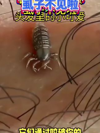 仁和药业百部酊喷雾剂男女阴用成人祛除虱子虱卵虱立净一扫光正品#长虱子怎么消除 #消除虱子卵的小妙招 #身上长虱子怎么消除 #草本植物 #百部酊喷剂