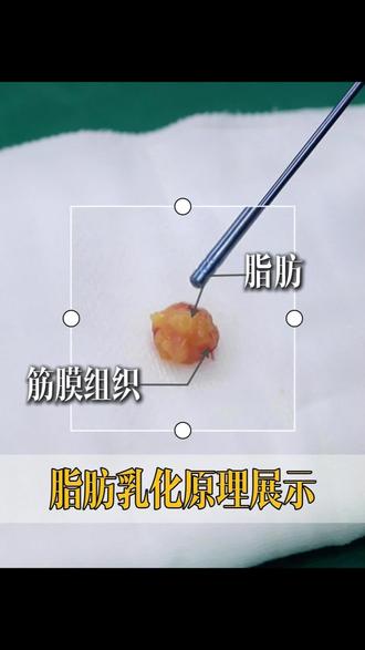 乳化就是炼油?原理演示,一次性看懂!#脂肪脂肪快走开 #济南整形郭广科 #蝴蝶袖拜拜肉 #腰腹赘肉 #创作灵感