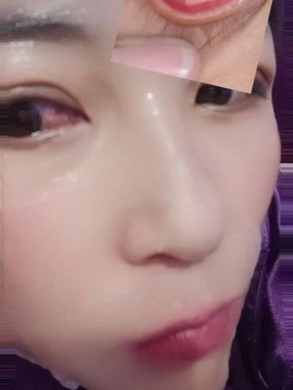 眼睛严重充血 又痛,😭直播请假 朋友们#看过来