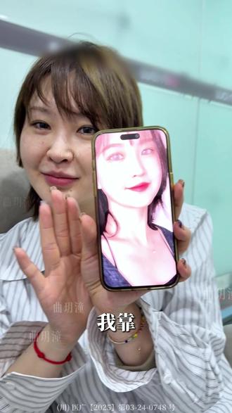 【全流程实录】人怎么能争气成这样! 仅做案例分享,出镜人已签署肖像协议#do脸 #变美逆袭 #头包脸 #注射 #面部提升