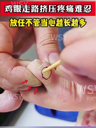 鸡眼千万不要放任不管,当心越长越深,试试我这个方法#鸡眼怎么去除 #鸡眼去除小妙招 #鸡眼怎么能彻底根治 #鸡眼怎么造成的 #鸡眼怎么办
