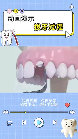 动画演示:拔牙过程 #牙齿 #拔牙