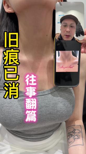 旧痕已消 往事翻篇 1洗掉的是纹身,放下的是过往,沉淀的是成长,圆满成功上岸。#洗纹身#杭州洗纹身#浙江洗纹身汪老师#