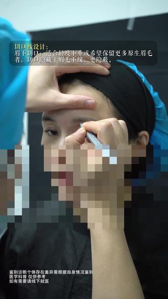 三角眼改善——眉下切口提升术前画线设计科普 #切眉 #眉下切口 #眼周年轻化 #三角眼 #整形医生陈波