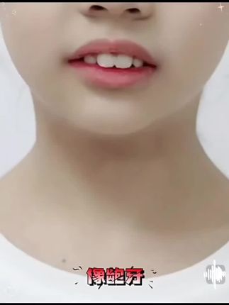 #牙套#牙齿矫正