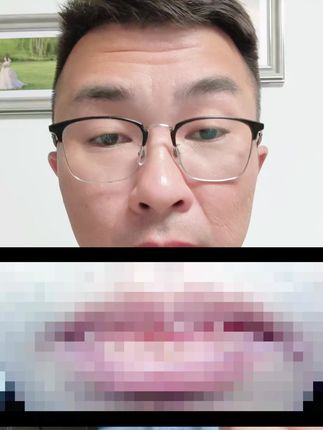 聚乙二醇润护敷料#嘴唇干