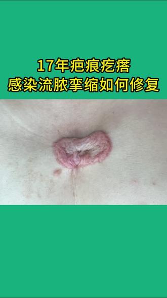17年前胸疤痕疙瘩感染流脓挛缩如何修复 #前胸疤痕疙瘩 #疤痕增生凸起 #疤痕修复 #疤痕疙瘩手术切除 #太原疤痕疙瘩