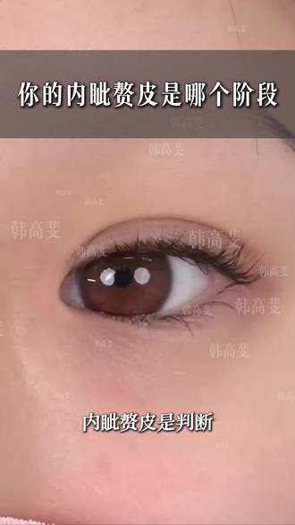 内眦赘皮分级,开眼角大小就看它! #双眼皮 #杭州双眼皮韩高斐 #内眦赘皮 #蒙古褶 #内眼角