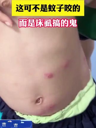 如果你经常浑身刺痒,头发易掉落,背上爱长痘,那么你的床上有螨虫在作怪!赶紧备上这个除螨包试试吧