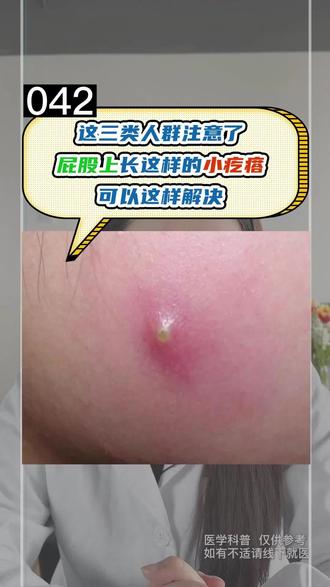 屁股瘙痒是什么情况 oAhelSIqItWTzmzbBgNyf4ANBhEXLprQAQNyEA~tplv-dy-resize-origshort-autoq-75:330.jpeg?x-expires=2007561600&x-signature=GEKBLWGgDBP4CYjAI0WlajzAuXo%3D&from=3213915784&s=PackSourceEnum_AWEME_DETAIL&se=false&sc=cover&biz_tag=pcweb_cover&l=202308170025138CFB0FBCC8935B306046