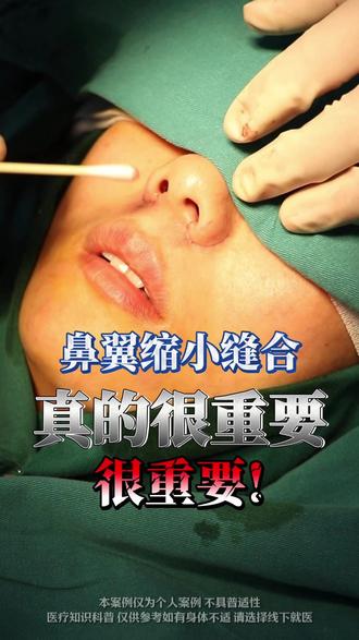 鼻翼缩小的缝合真的很重要!很重要! #鼻翼缩小 #缩鼻翼 #整形医生李勇