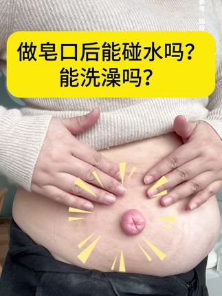 做了皂口后能碰水吗?能洗澡吗?#造口袋#一件式 #二件式造口袋 #造口人洗澡