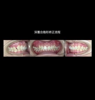 深覆合隐形矫正,设计要点