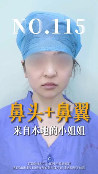 百台挑战第二季NO.115鼻翼缩小+鼻头缩小 #鼻翼缩小 #鼻头缩小 #缩鼻翼 #缩鼻头