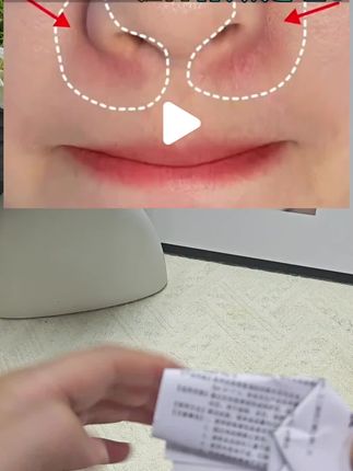 鼻翼脂溢性皮炎#鼻翼泛红 #鼻翼卡粉 #鼻翼脱皮 #鼻翼红血丝 #红血丝修复