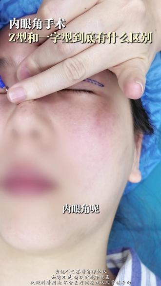 内眼角的形状有什么区别 #内眼角 #双眼皮手术 #钟清娣 #广州双眼皮 #双眼皮知识