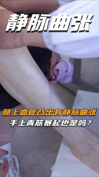 腿上血管凸出有静脉曲张,手上青筋暴起也是吗? #静脉曲张 #门诊 #医生 #知识科普 #抖音健康使用计划