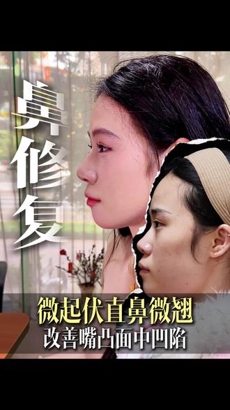 鼻修复 改善嘴凸面中凹陷,蜕变微起伏直鼻微翘 #鼻修复 #鼻整形 #深圳鼻子 #李兴