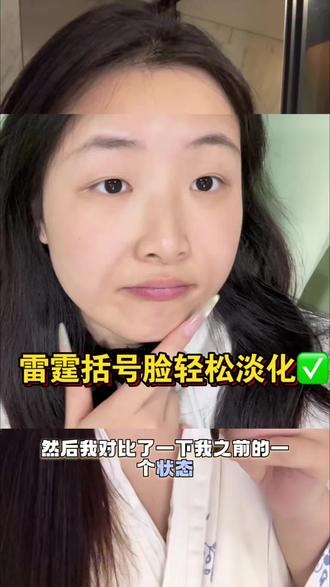 雷霆(括号脸)消失术‼️#法令纹 #淡化法令纹 #法令纹改善 #垮脸救星 #原相机无美颜