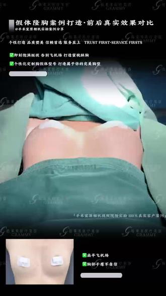 #邵阳假体丰胸#邵阳格莱美