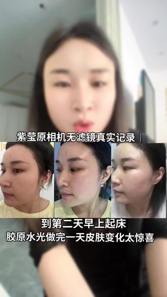 好多姐妹都好奇我昨天做胶原水光效果,我来汇报咯,
做之前素颜暗沉泛红、斑点痘印、肤色不均
做完当下:皮肤有点红,皮肤瞬间水光充盈,粗糙感消失,脸蛋嫩到发光
睡一觉今早起床:原相机素颜状态直接开挂
泛红消退,肤色整体提亮匀净,毛孔细腻,皮肤通透有光泽,太爱了#分享我的护肤经验 #素颜肌效果对比 #护肤对比图 #真实护肤对比 #敏感肌护肤