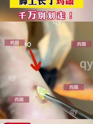 脚上长的鸡眼,一定不要拖忍抗#鸡眼 #鸡眼跖疣 #鸡眼去除小妙招 #脚底板的老茧怎么清除 #小脚趾长硬茧怎么办