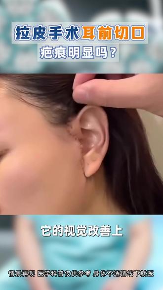 拉皮手术的切口会很明显吗? #拉皮切口 #拉皮手术 #拉皮疤痕 #面部提升 #大拉皮无疤痕操作