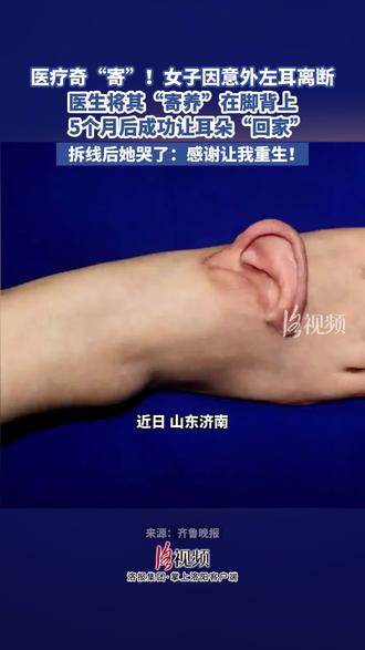 医疗奇“寄”!女子因意外左耳离断,“寄养”脚背5个月