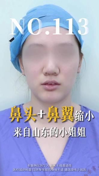 鼻翼缩小百台挑战第二季NO.113鼻头+鼻翼缩小 #鼻翼缩小 #鼻头缩小 #缩鼻翼 #整形医生李勇