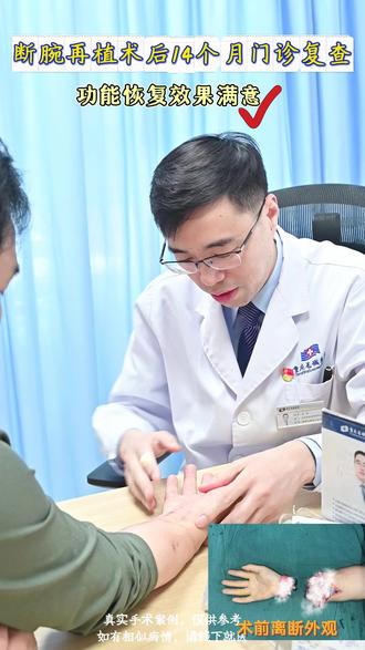 腕部完全离断再植术后14个月门诊复查,手部活动效果令人满意, 配合进一步功能重建,手会变得更加灵活#再植术 #断腕再植 #肢体离断 #抖出健康知识宝藏 #重庆长城骨科医院田林