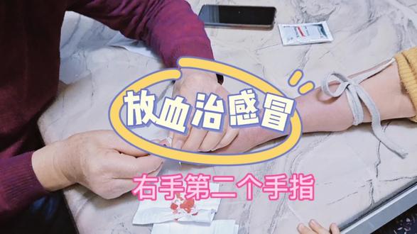 山西土方法——放血治新冠,你想知道怎么个操作方法不,婆婆都被扎哭了😄😄😄😈😈😈#希望疫情早点结束恢复正常生活 #放血疗法 #vlog日常 #疫情下的生活 #记录真实生活
