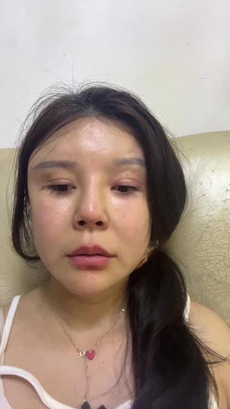 我是左右失明跳舞摔腿后一个人在家呆久了抑郁开始的,我一开始也没在意,疼就忍着,难过就哭!就是这样拖了病重了,所以大家一定要重视自己身体的真实感受,爱自己,爱家人!#视网膜脱落 #双相情感障碍 #恶人传