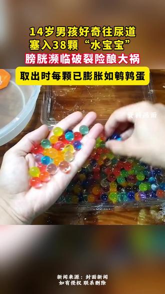 14岁男孩好奇往尿道塞入38颗“水宝宝”,膀胱濒临破裂险酿大祸,取出时每颗已膨胀如鹌鹑蛋。(来源:封面新闻)