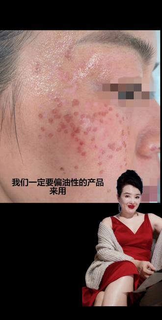 为什么脱皮后,返黑#祛斑