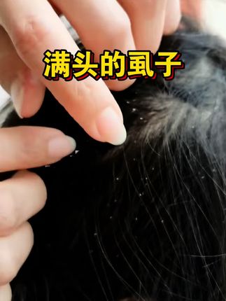小孩头上长虱子,就用仁和百部酊喷剂,成分温和不伤肤 #头上长虱子 #虱子 #虱子药大人小孩通用 #仁和复方百部酊喷剂