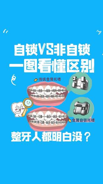 🔍托槽价格差几千的秘密!这笔账你算对了吗? ~自锁vs非自锁~这本质上是一道选择题:
🔶若预算宽松,且看重时间效率、佩戴舒适感和便于清洁,自锁托槽的长期体验价值更突出。
🔶若预算有限,且有耐心配合常规复诊和细致清洁,技术成熟、性价比高的非自锁托槽是稳妥之选
✨✨最终决定前,别忘了这三个关键因素:
· 🏙️城市与机构:不同城市和等级的医疗机构,其收费标准、医生经验可能不同
· 👩⚕️🧑⚕️医生方案:你的牙齿具体情况是核心,最终方案必须由专业正畸医生面诊后确定
· 🥰自身配合:日常维护(如口腔清洁)和定期复诊同样至关重要
⚠️本文仅为口腔正畸器材的知识介绍,不可替代专业医疗建议。矫正方案需由执业医师面诊后制定
#牙套 #带牙套牙套的日子 #整牙历程 #科普 #选择困难症
