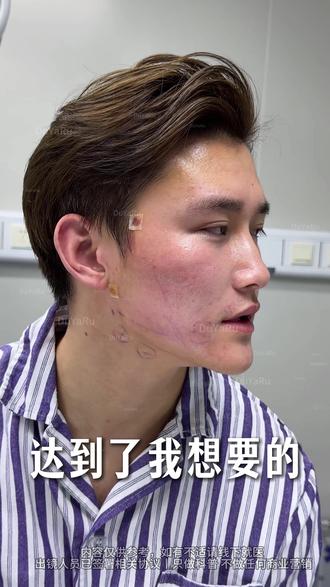 告别发腮去姨味,get清晰下颌线 效果因人而异,具体项目需经医生面诊评估为主!
出镜人已满25周岁!
出镜人已签署相关肖像授权,此视频不宣导任何风险医疗项目#上海杜亚如#面部提升#肉肉脸#面吸#双下巴