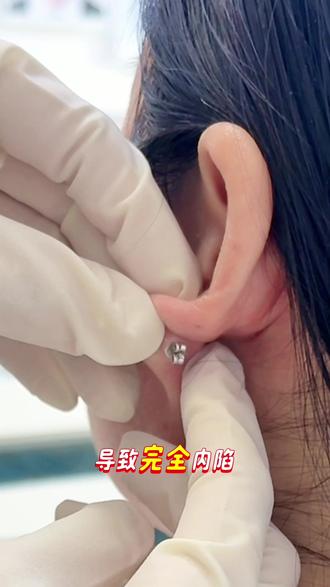 #蝴蝶扣
尽量不要带蝴蝶扣,如果耳朵比较厚,带蝴蝶扣容易挤压导致内陷。扣太紧容易陷进去,导致耳洞变大豁开!#耳骨钉 #手工穿戴