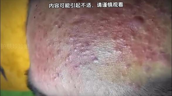 铁汁们这期真的太饱满了#解压挤痘痘 #强迫症治愈系 #痘痘黑头粉刺拜拜 #黑头清理 #解压