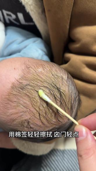 教大家一个简单轻松去除头垢的好办法,第一步先铺上隔尿垫,用棉签轻轻把油涂滴在发根,软化头垢,橄榄油,抚触油,山茶油,花生油,食用油都可以,第二步包上保鲜膜(为了更快软化,也防止宝宝哭闹抱起来不会蹭得衣服都是油)等待30分钟,这个时候如果宝宝不配合就拿玩具哄哄,第三步用棉签轻轻弄掉,第四步,用宝宝专用洗发水多洗几遍。洗干净用棉柔巾擦干等待自然风干就好了,不能用吹风机噢,如果太多就分两次弄,最好第二天再弄。头皮红是正常的,因为宝宝皮肤娇嫩。囟门那里一定要轻轻的弄,今天本来想带孩子去剃头的,但是想想冬天这么冷。剃了头也难看,还是留长发。宝宝第二第三个月最容易长头垢,最好弄干净,可能真的很痒,只是宝宝不会说,因为看她经常抓头皮。如果有黄色结块凸起的是溢脂性皮炎,这种建议去医院。头垢是出生的时候头顶有层白白的胎脂,像头皮屑一片片这种可以弄。#新生儿头垢怎么洗 #育儿经验分享 #婴儿头垢怎么清除 #婴儿胎脂头垢怎么消除 #新手宝爸宝妈