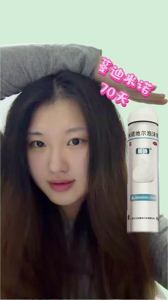 蔓迪米诺70天
#蔓迪 #米诺地尔#生发