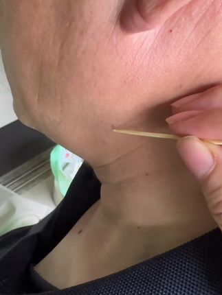 @佰草钟医绿客源专卖店手足护理6号 #脖子上长小揪揪 #脖子上的小肉粒 #疣 #疣体 【第一类医疗器械备案号/产品技术要求编号】医疗器械备皖阜械备20230005 仔细阅读产品说明书或在医务人员的指导下购买和使用 禁忌内容或注意事项详见说明书 内容仅供参考,如有不适请线下就医