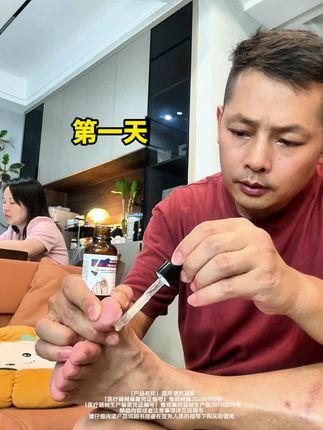 坚持每天涂,一定要和家人分开用#灰指甲