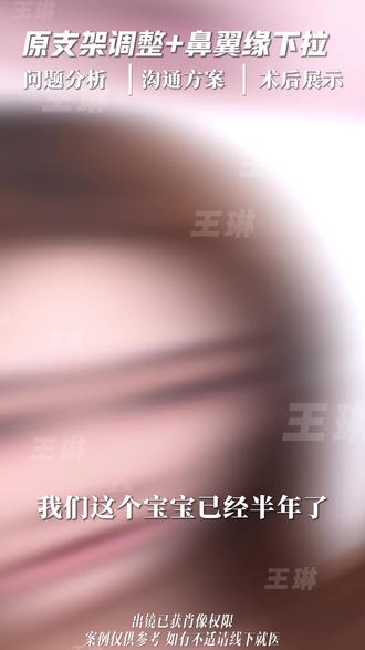 短鼻延长|小猪鼻爆改 #露鼻孔 #微起伏 #直鼻微翘 #鼻修复