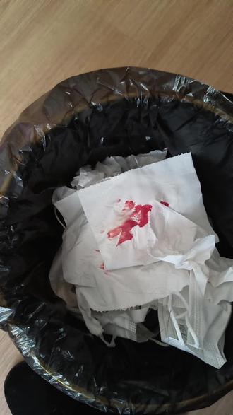 鼻子流血为什么眼睛也流血百科在线 鼻子流血为什么眼睛也流血百科在线