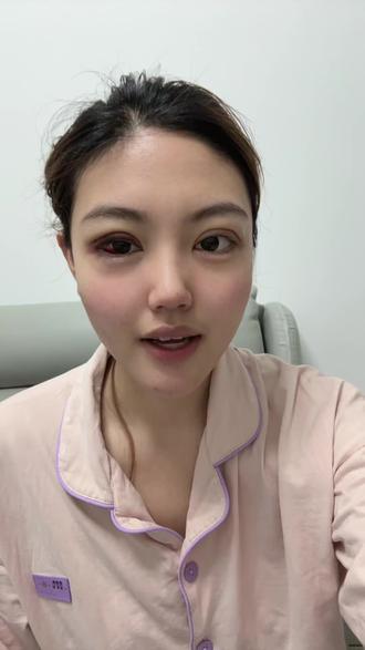 埋线第四天,做完之后有一点后悔,因为我觉得完全没必要做这个埋线,等待七天之后看看效果#内容太过真实 #陈姜楠 #埋线