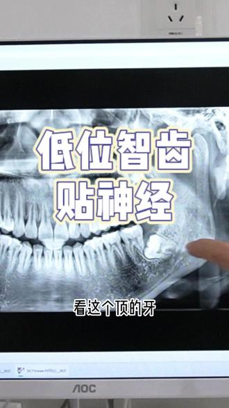 低位智齿贴神经拔除 #沈阳拔智齿 #低位智齿