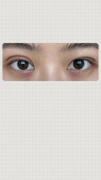 双眼皮不对称怎么办 #双眼皮修复 #双眼皮 #双眼皮不对称 #双眼皮练才华 #成都双眼皮