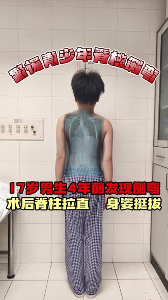 13岁发现侧弯30多度,保守治疗4年度数不降反增到了50多度 侧弯仍在加重,高低肩、身体歪斜……
眼看就要高考,家长果断决定:高二暑假手术,不让孩子带着“歪”的身体上考场。
如今恢复良好,全力以赴冲刺高考。
#特发性脊柱侧弯 #北京大学第一医院脊柱侧弯