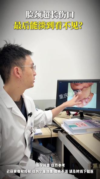从脸到整个脖颈的大面积创伤,有办法修复吗 #疤痕遮盖 #挛缩性疤痕 #重庆医疗美容张书豪 #瘢痕 #大面积烧伤